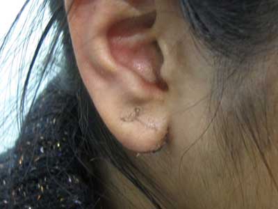 Suture-less EarLobe Repair